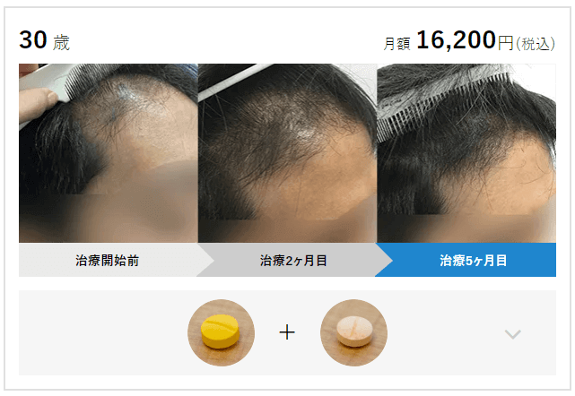 AGA治療 効果