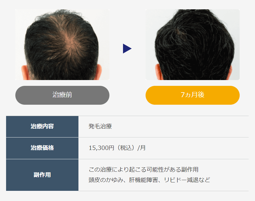 AGA治療 効果
