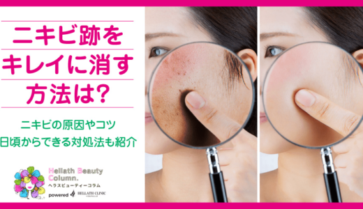 ニキビ跡をキレイに消す方法は？ニキビの原因やコツ・日頃からできる対処法も紹介