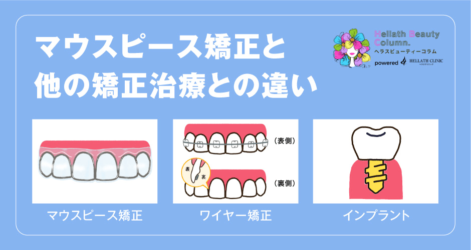 マウスピース矯正メリットデメリット_他の矯正治療との違い