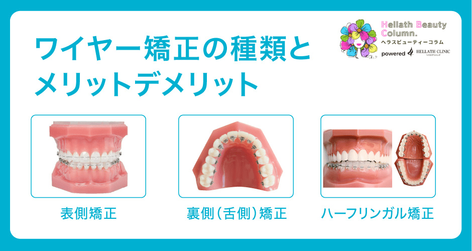 ワイヤー矯正とは_メリットデメリット