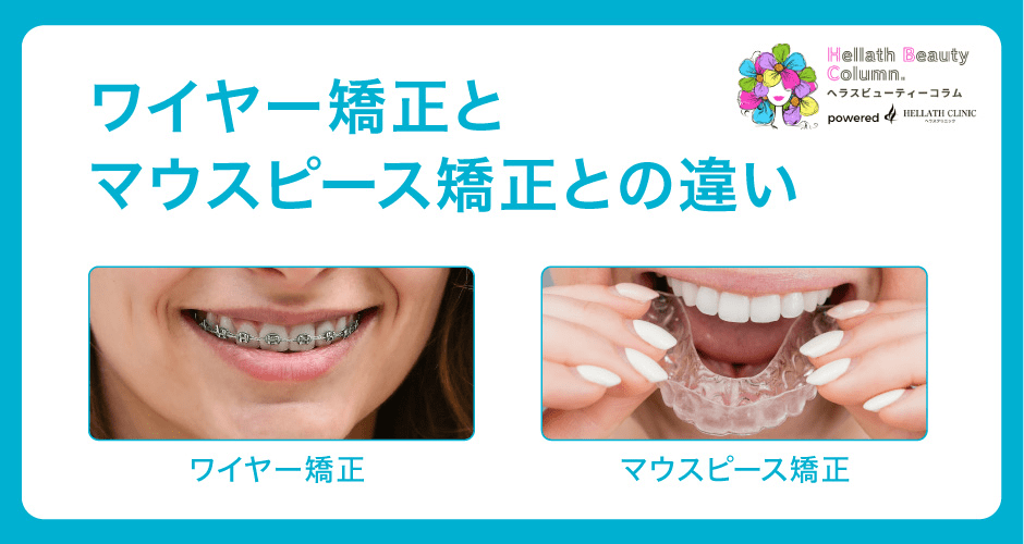ワイヤー矯正とは_違い