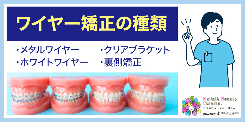 ワイヤー矯正値段_種類