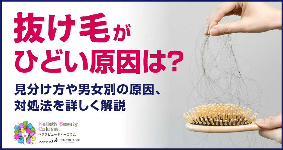 抜け毛がひどい_アイキャッチ