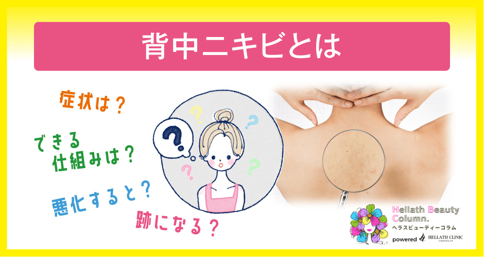 背中ニキビ_背中ニキビとは