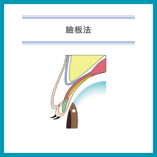 二重整形_おすすめ