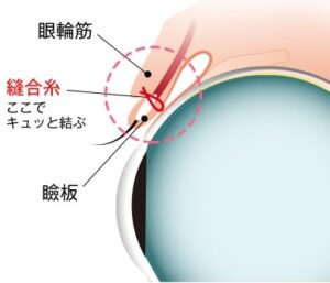 二重整形_おすすめ