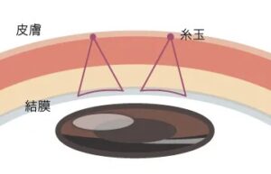 二重整形_おすすめ